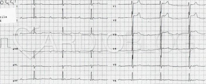 EKG szív egészsége)