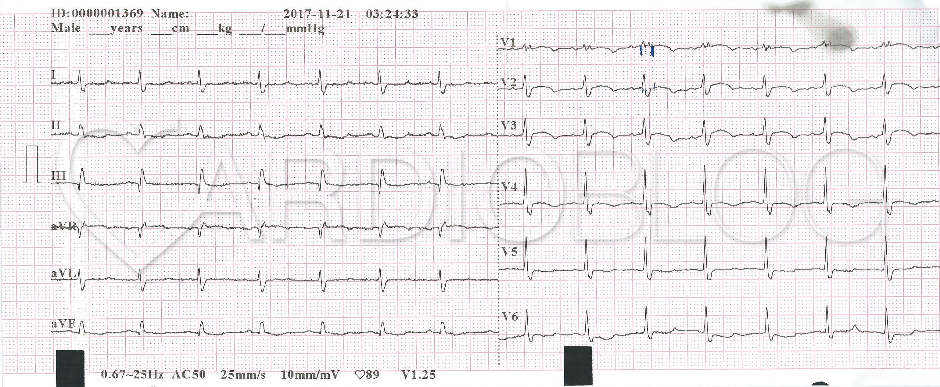 ekg fogyás)