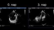 SZE_thrombus1abra_anterior