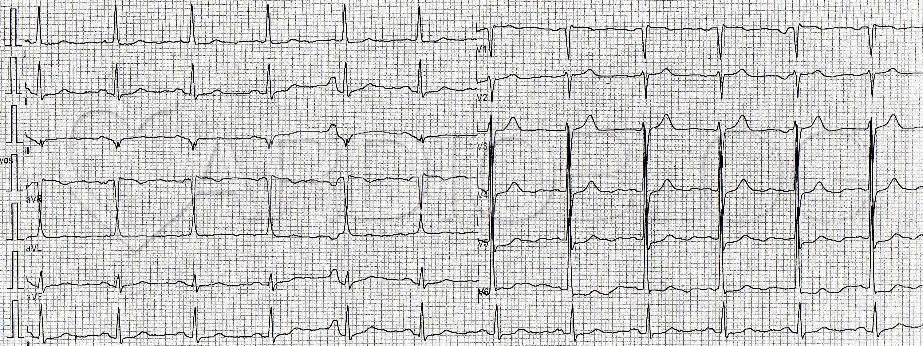 a hipertónia látható-e az EKG-n