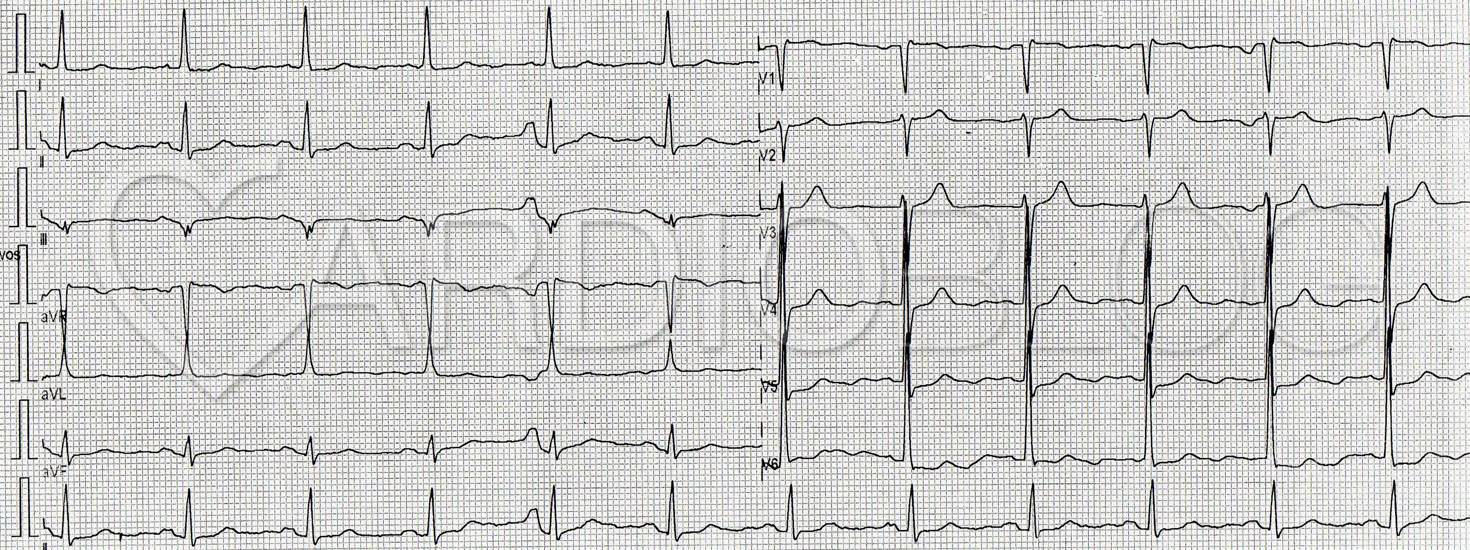 a hipertónia látható-e az EKG-n magas pulzus kezelése gyógynövénnyel