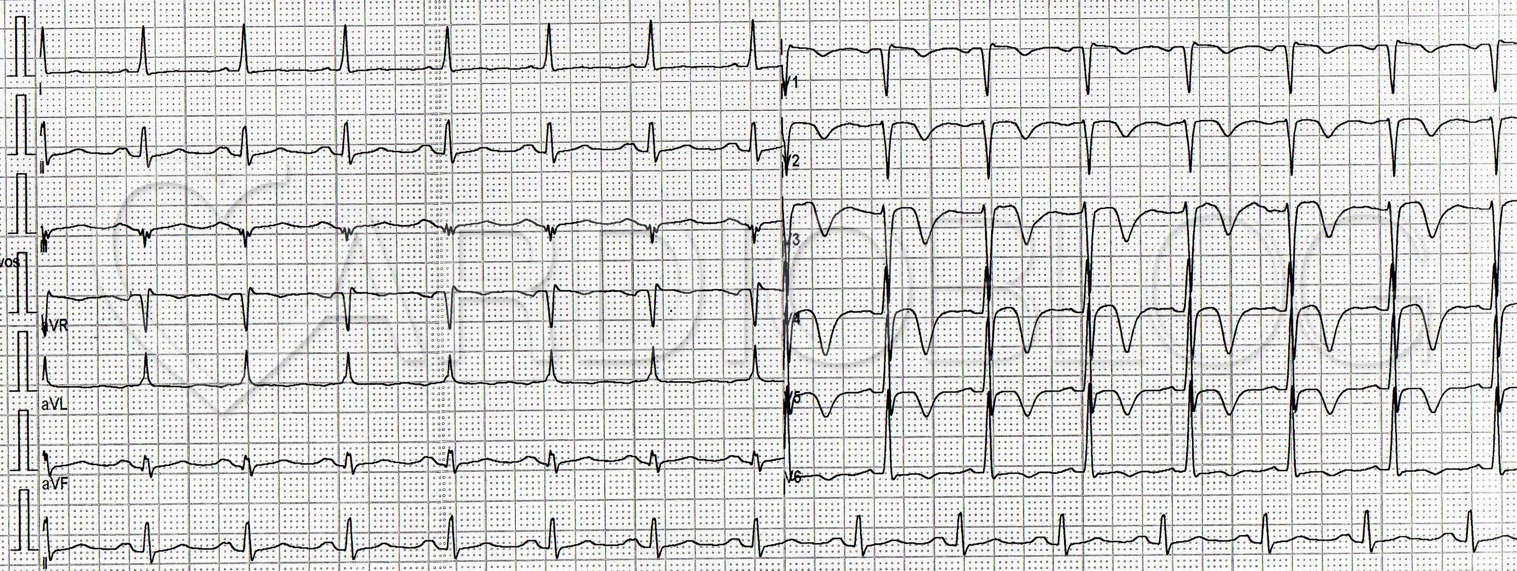 Hogyan készüljünk fel a szív EKG-jére? - Szívizomgyulladás November