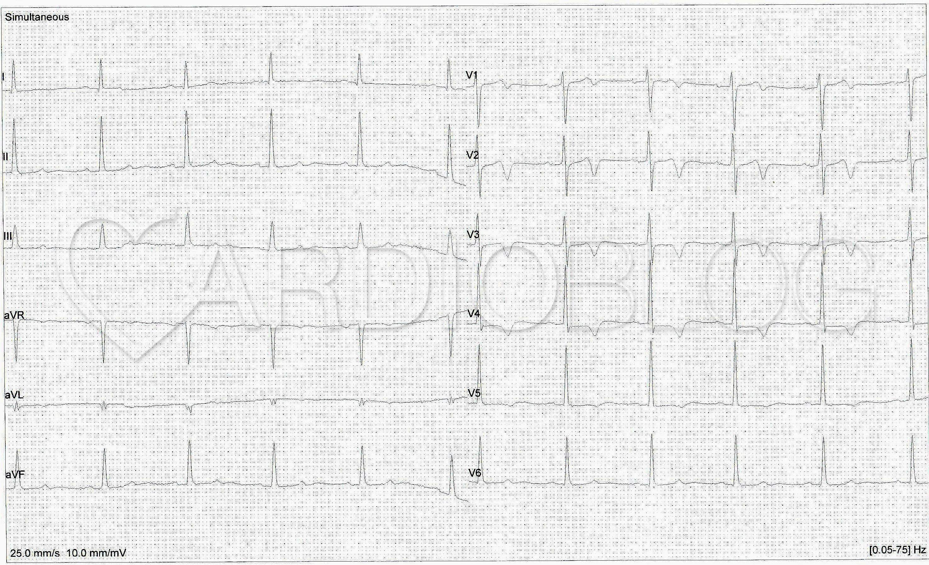 a hipertónia látható-e az EKG-n magas vérnyomás és visszér kapcsolat