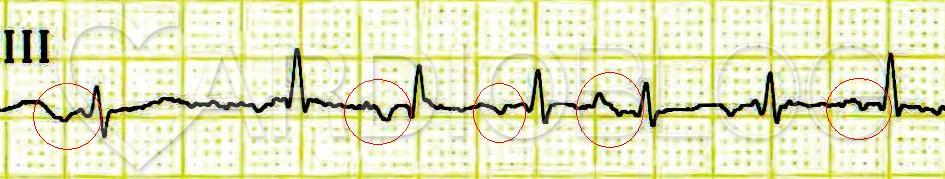 Holter EKG monitorozás - mi az és hogyan történik