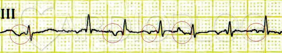 EKG: hogyan kell csinálni? Előkészítés, lépésről lépésre