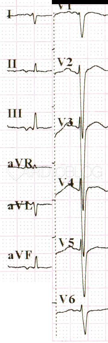EKG átirat hipertónia esetén