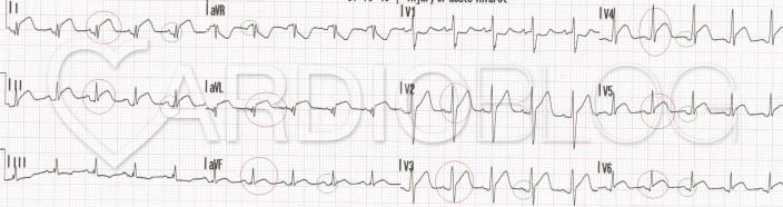 Egyetlen coronaria ellátási területének nem megfeleltethető, nem összetartozó elvezetésekben, szinte mindenhol látható ST eleváció. Jellegzetes PQ depresszió, illetve aVR-ben PQ eleváció. 