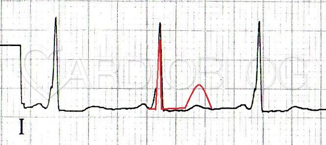 az ecg magas vérnyomást mutat