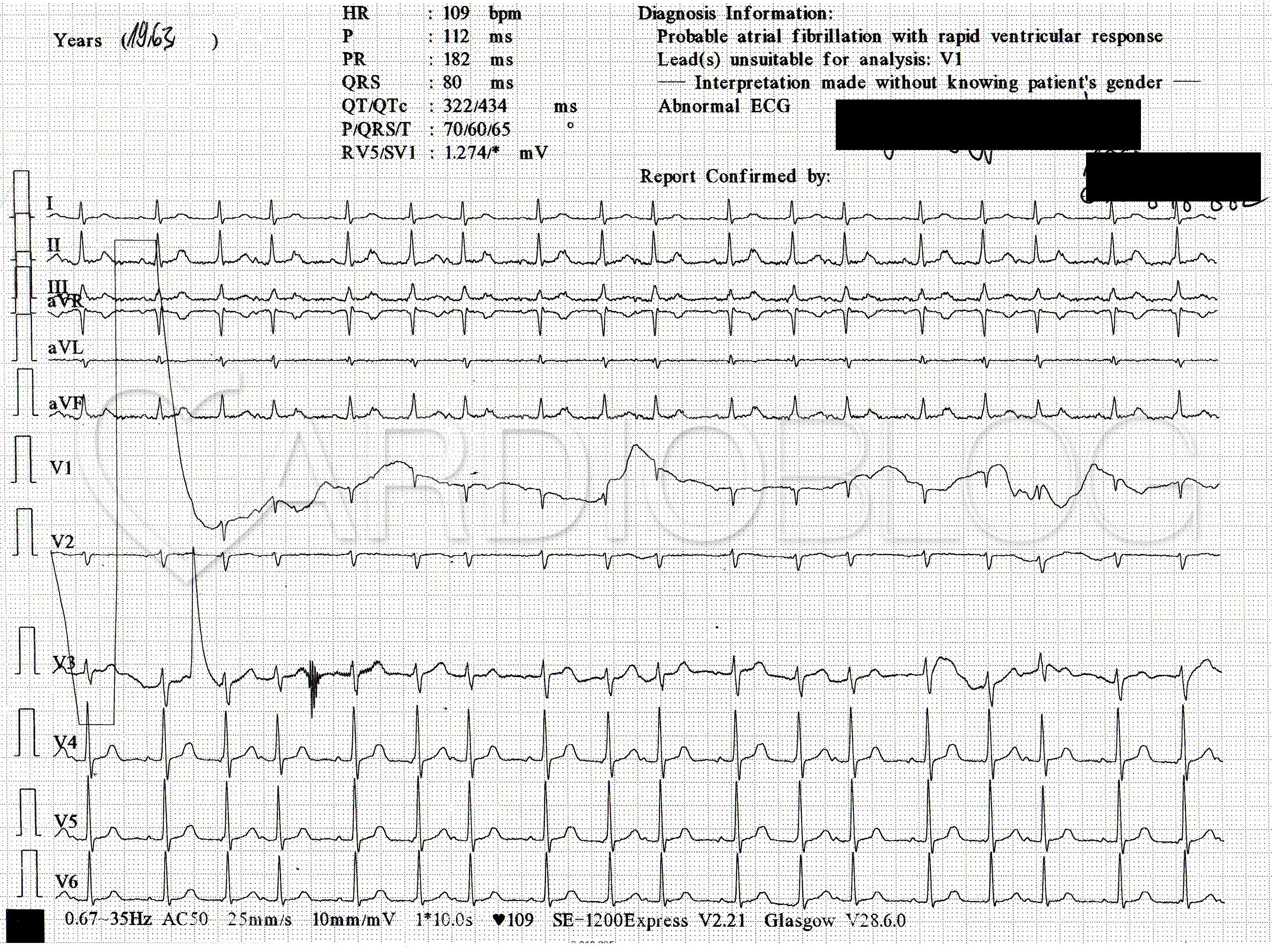 magas vérnyomás és sinus bradycardia