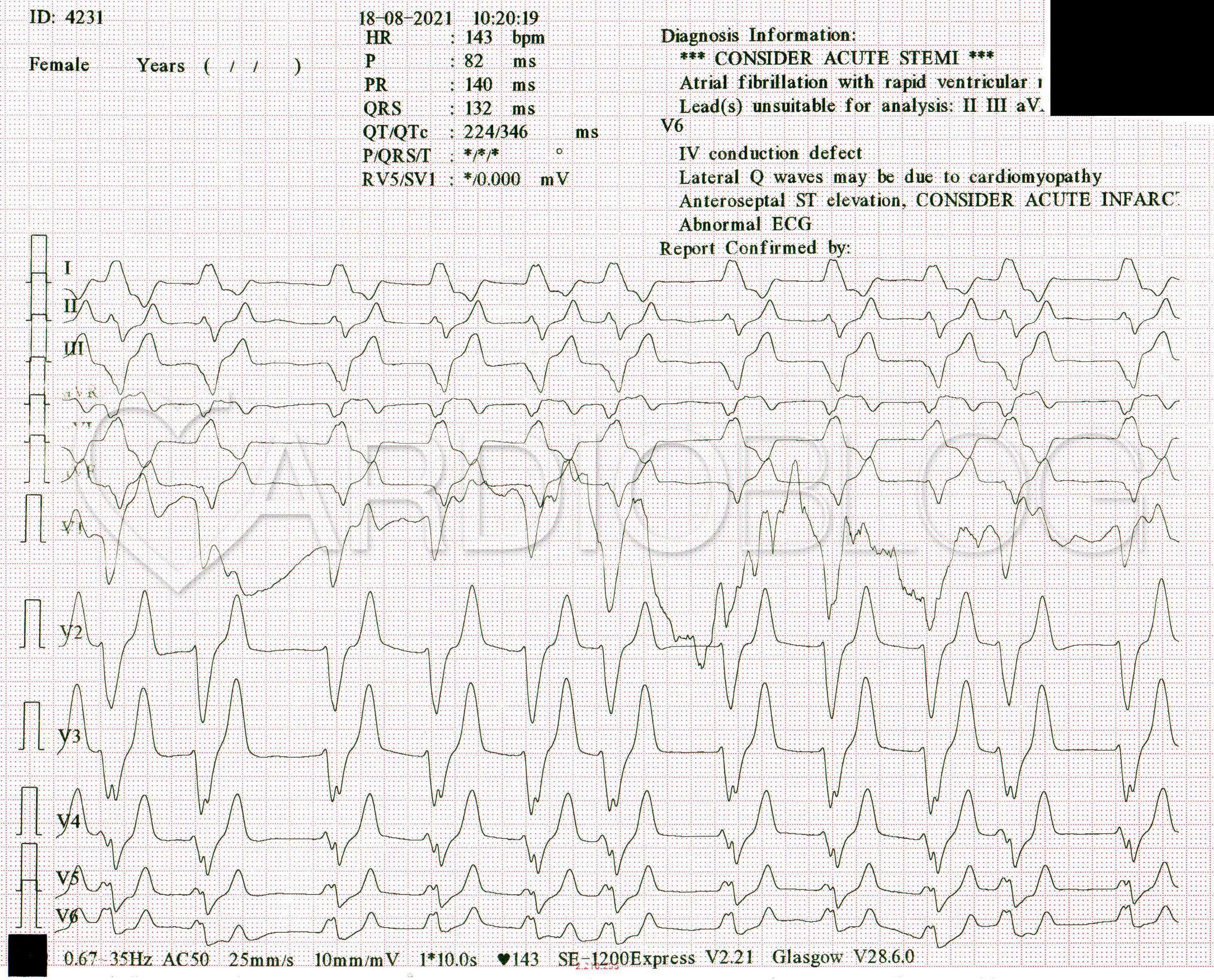 az ecg magas vérnyomást mutat alacsony vérnyomás víz ivás