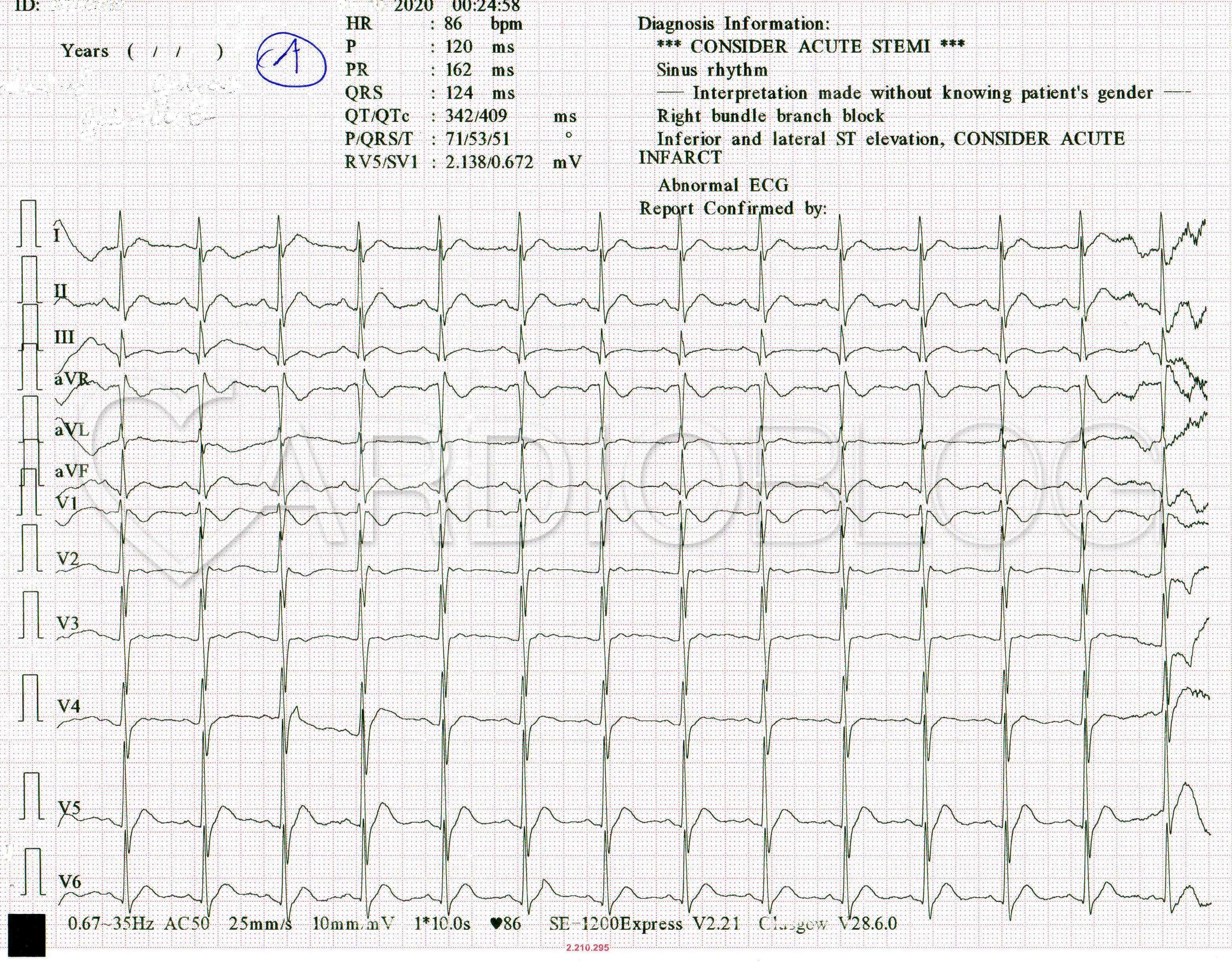 magas vérnyomás sinus tachycardia