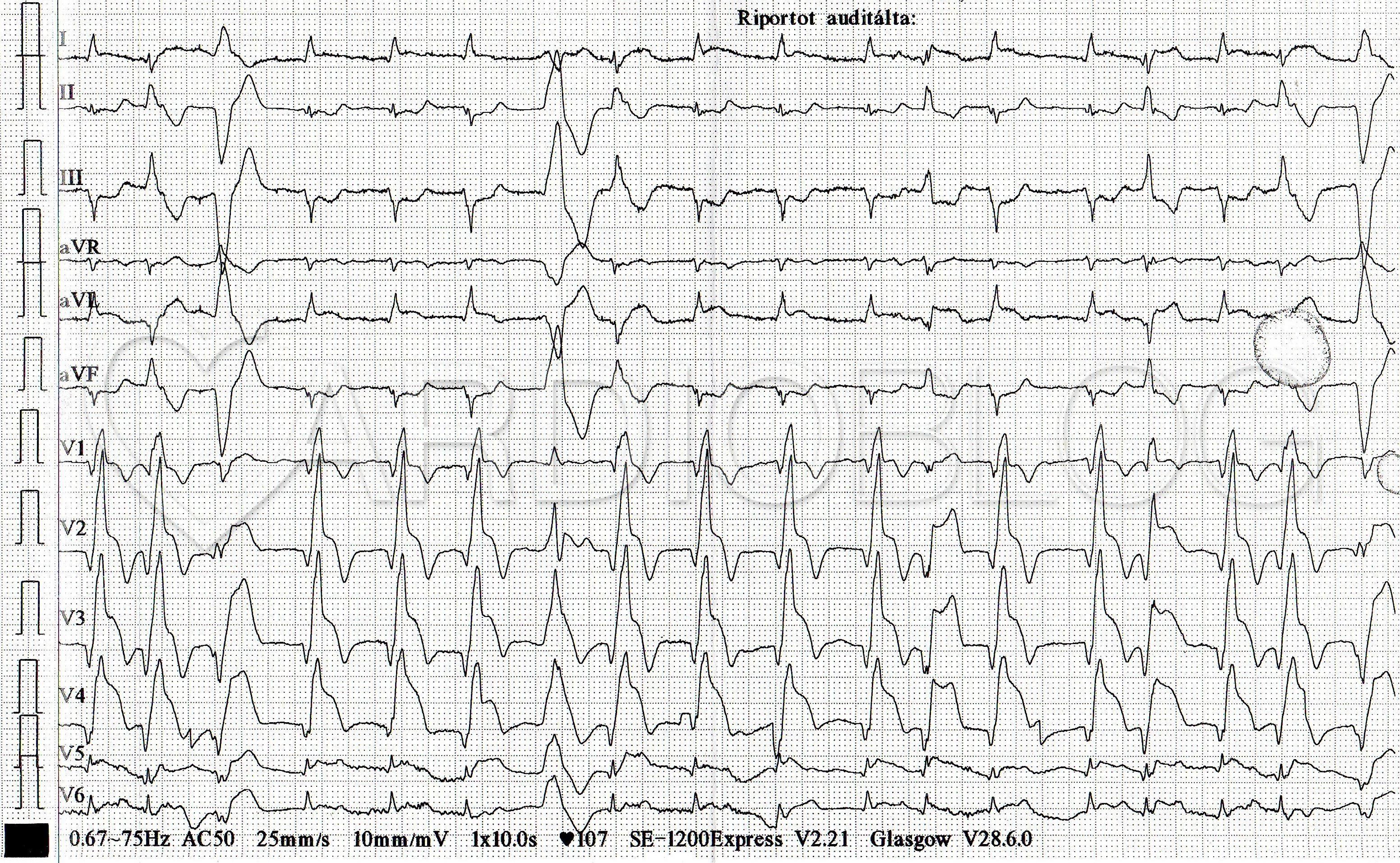 magas vérnyomás és sinus bradycardia)