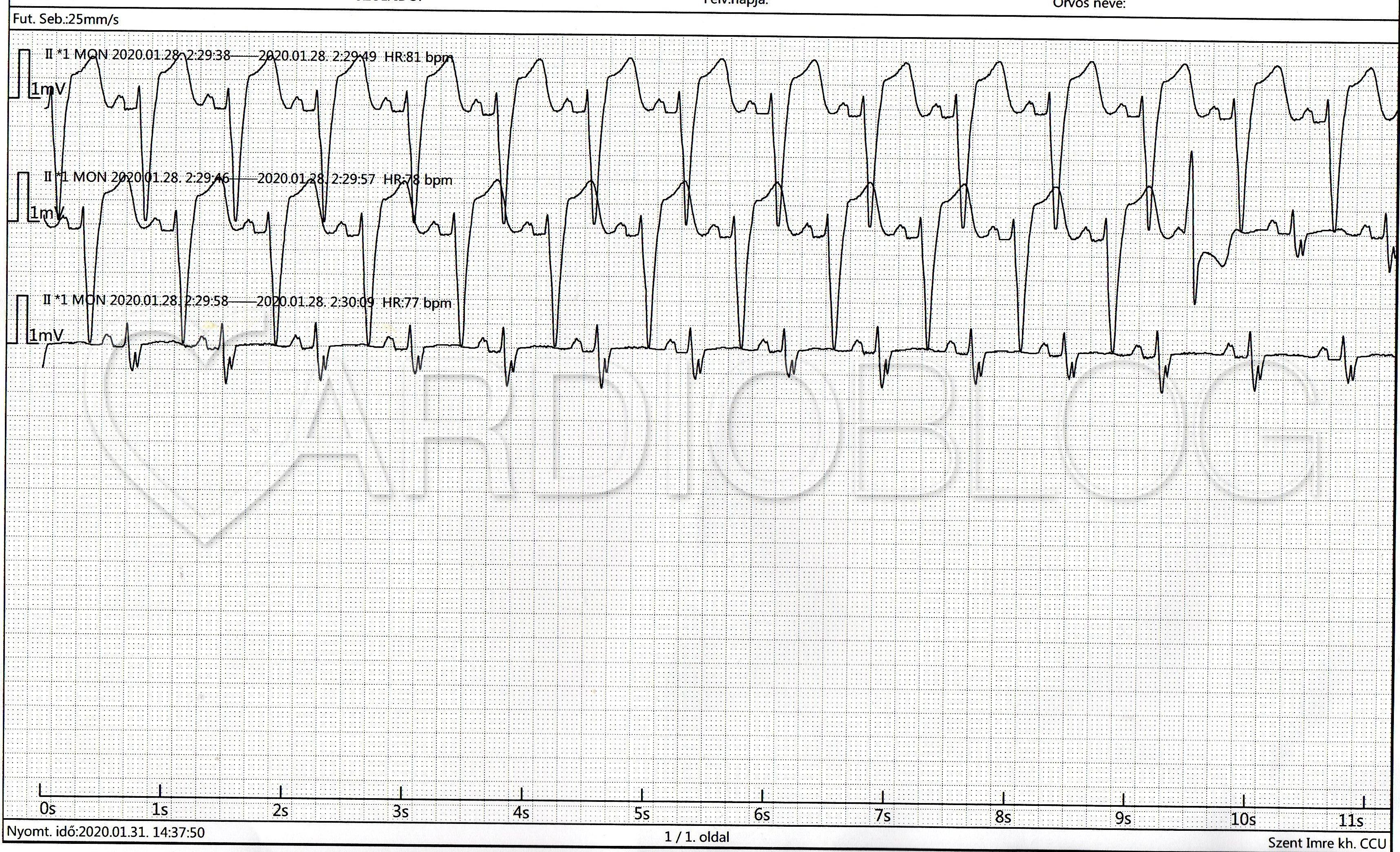 hogyan kezelhető a tachycardia magas vérnyomással