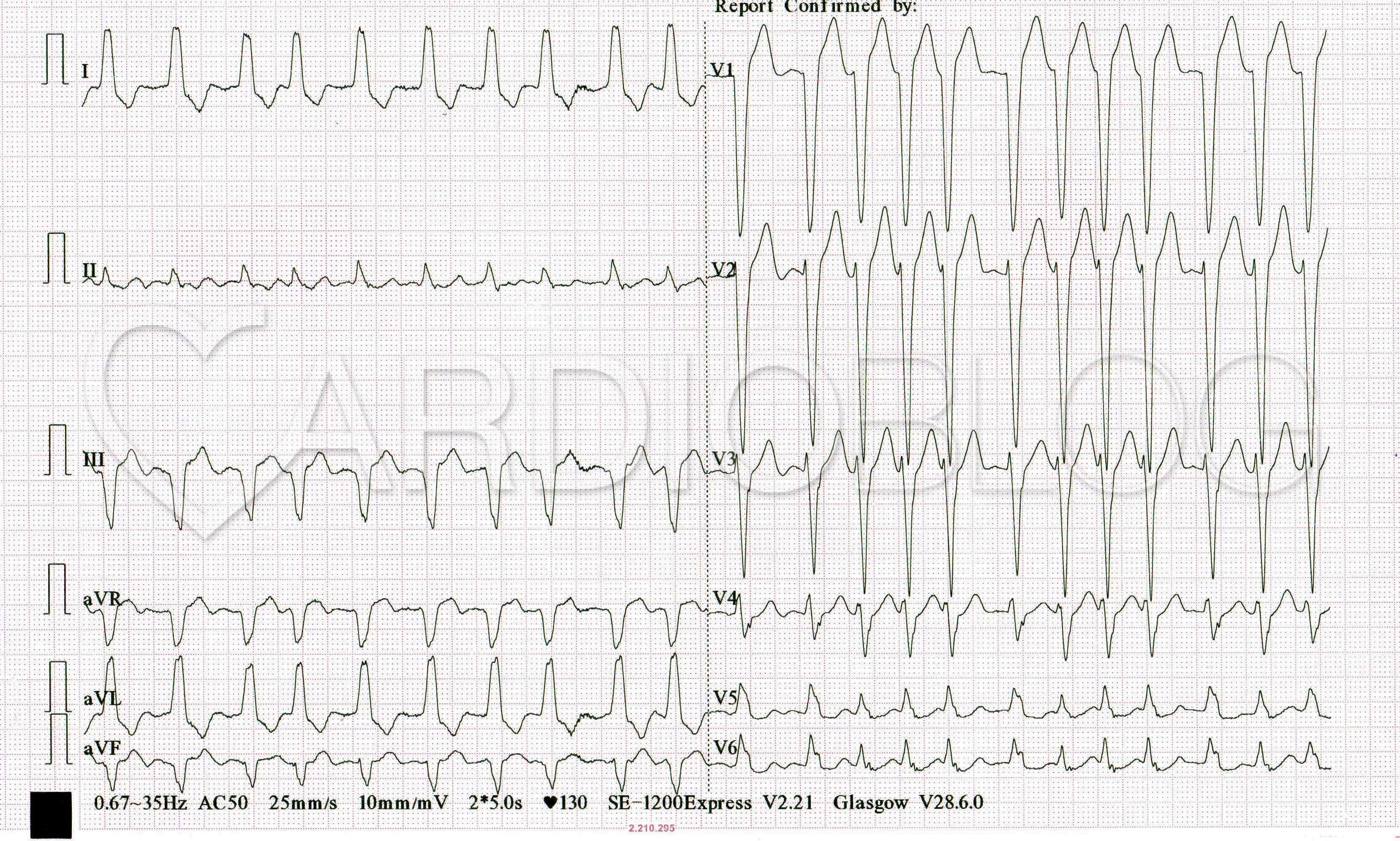 hogyan kezelhető a tachycardia magas vérnyomással a magas vérnyomás kezelésének története