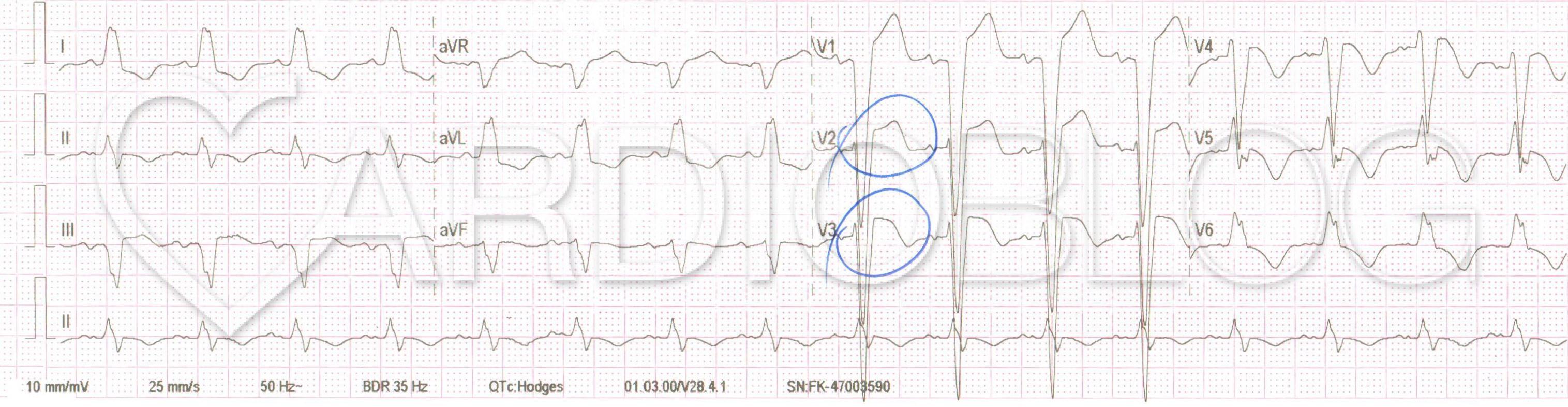 magas vérnyomás sinus tachycardia