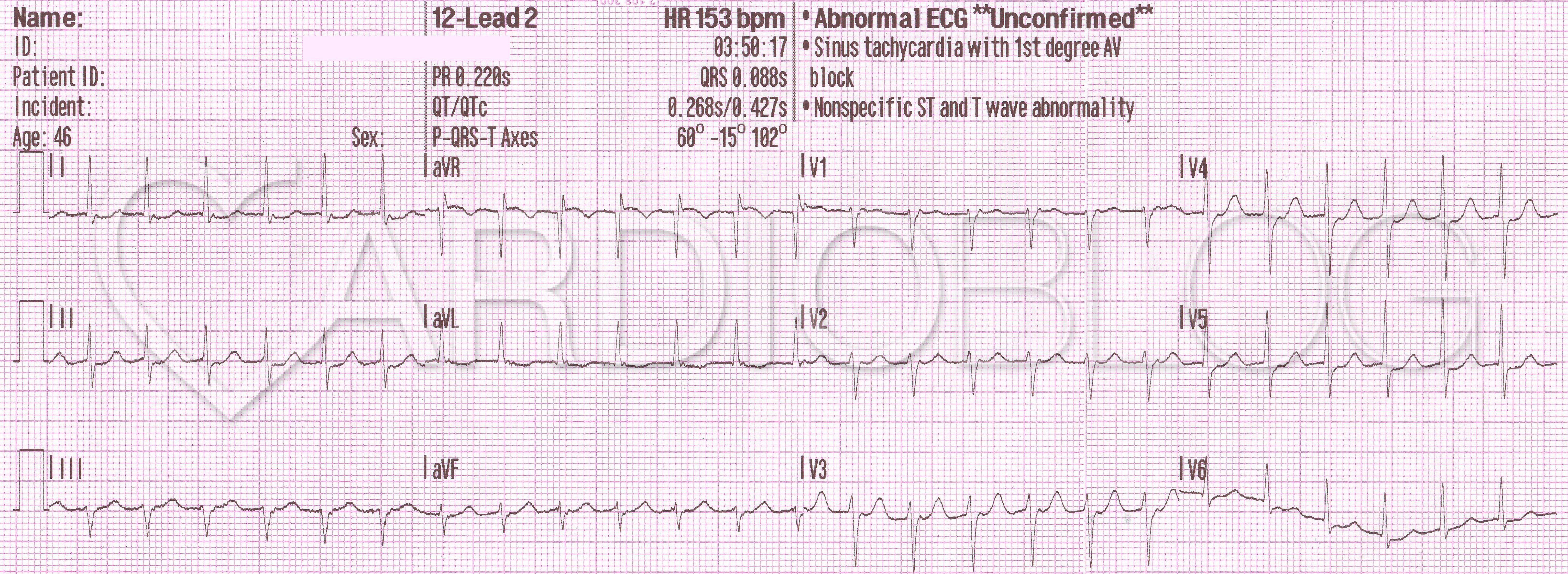 magas vérnyomás sinus tachycardia