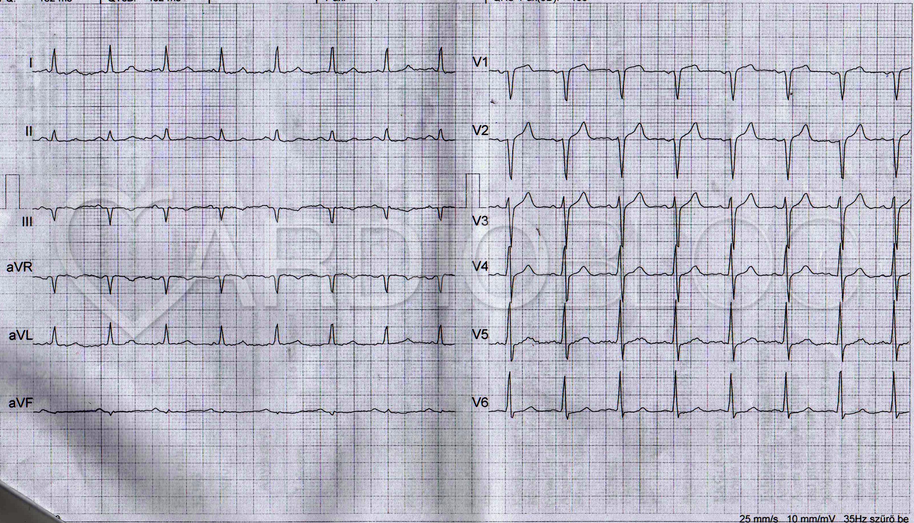 Tachycardia oka és tünete