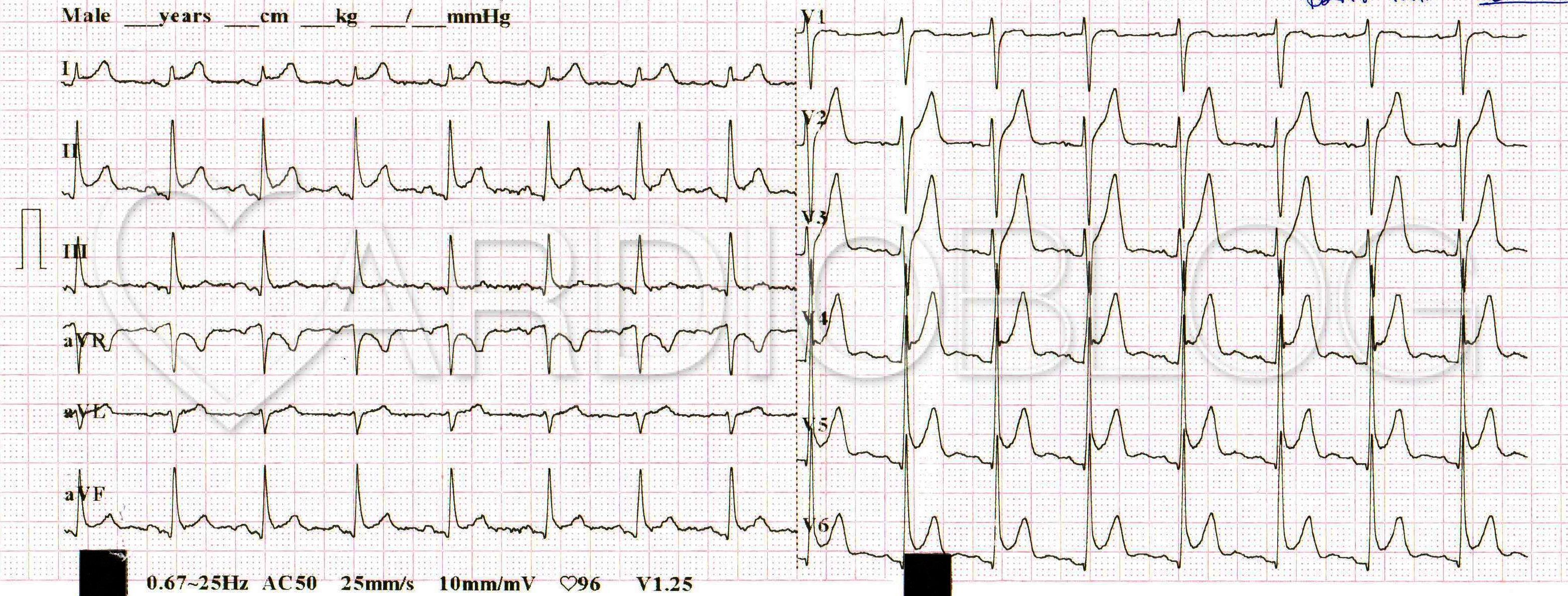 szívritmuszavar ekg