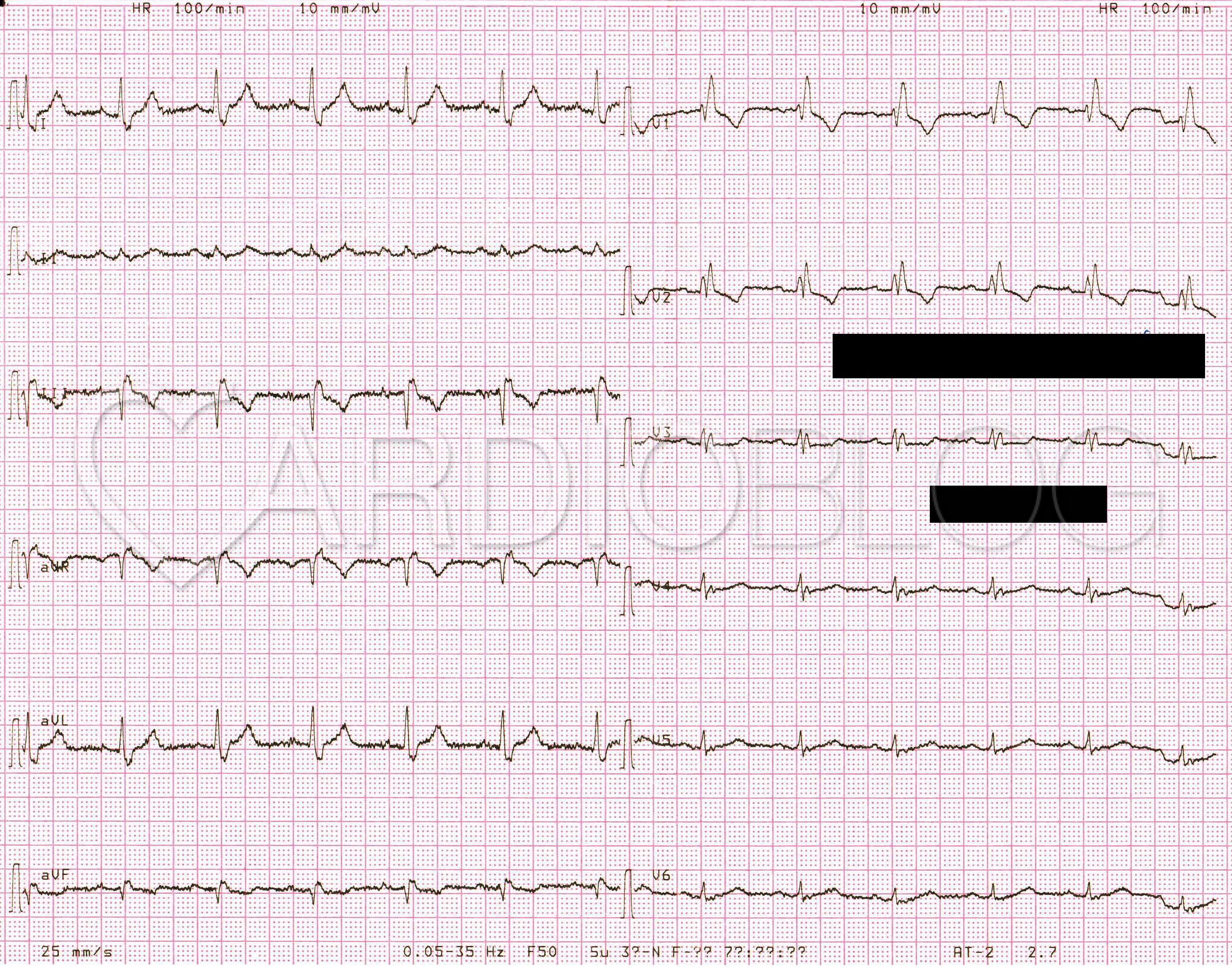 a hipertónia látható-e az EKG-n köszvény és magas vérnyomás kombinációja