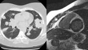 sarcoidosis_key_image