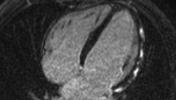 Myocarditis